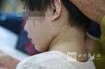 黑河5岁女童遭继母哥哥虐待 9根肋骨骨折左小腿骨折 - 新浪黑龙江