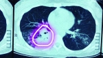 肺部CT显示，画圈的部分为大白肺 - 新浪黑龙江