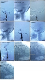 术前、术中和术后造影及球扩后流通的血管 - 新浪黑龙江